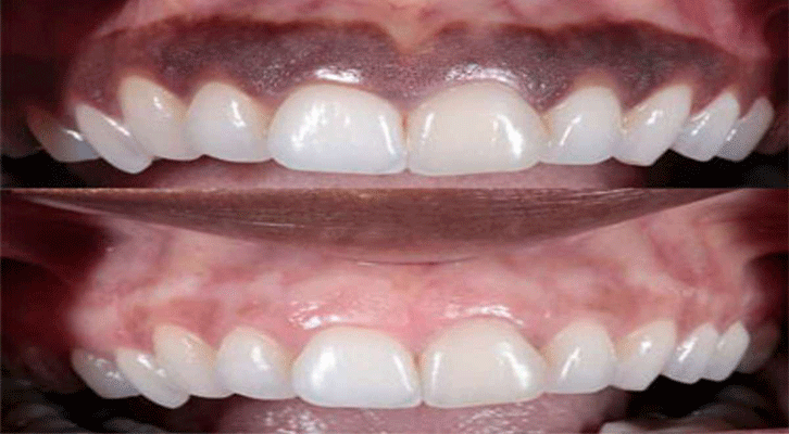 Gum Depigmentation