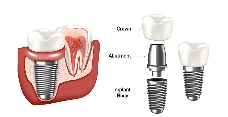 Dental Implants at Siddhant dental Clinic Bibewadi, Pune