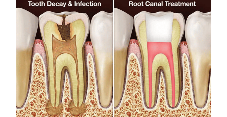 Root Canal Treatme at Sidhhant Clinic Bibewadi, Pune